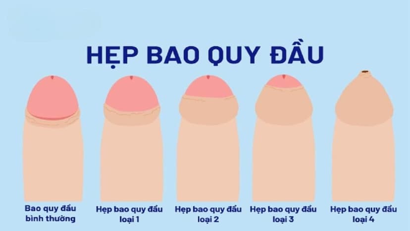 Hẹp bao quy đầu là gì? Dấu hiệu nhận biết ở người lớn và trẻ em