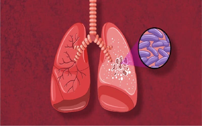 dấu hiệu bệnh lao phổi ở người lớn