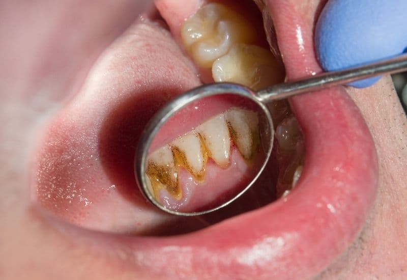 Lấy cao răng có ảnh hưởng đến men răng không?