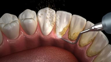 Lấy cao răng có ảnh hưởng đến men răng không?