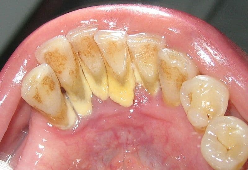 lấy cao răng có tốt không