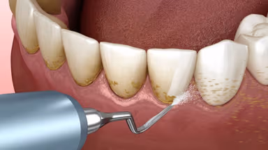 Lấy cao răng có tốt không?