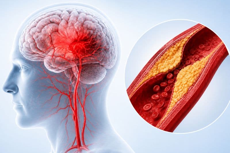 Tầm quan trọng và cách đánh giá tổn thương mạch máu não