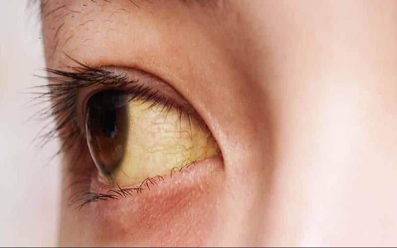 Mắt vàng là dấu hiệu bệnh gì?