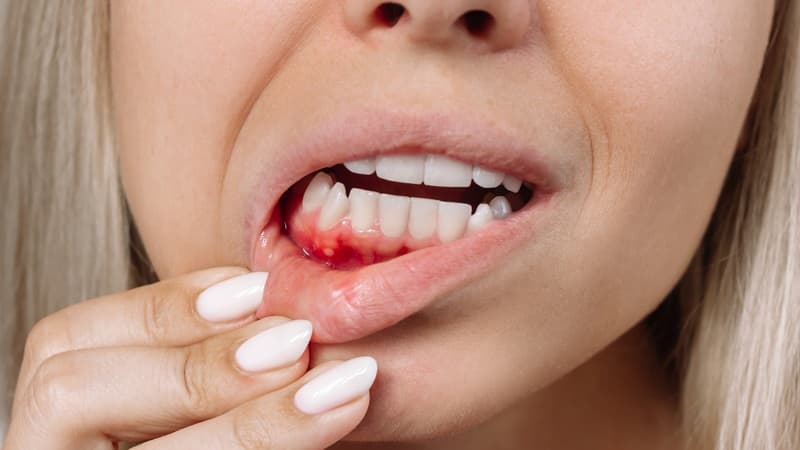 mẹ bầu bị viêm lợi phải làm sao