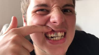 Men răng bị đen có chữa được không?