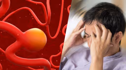 Phình động mạch não có nguy hiểm không?