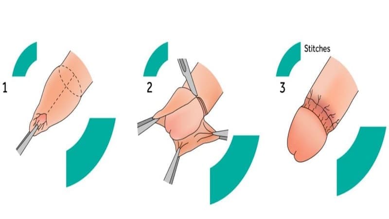 cắt bao quy đầu có đau không