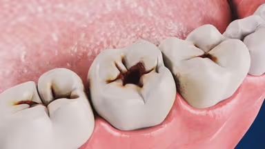 Răng sâu độ 2 là như thế nào?