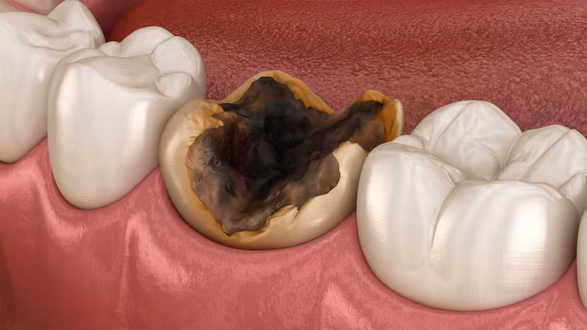 Răng số 6 bị sâu vỡ có nên nhổ không?