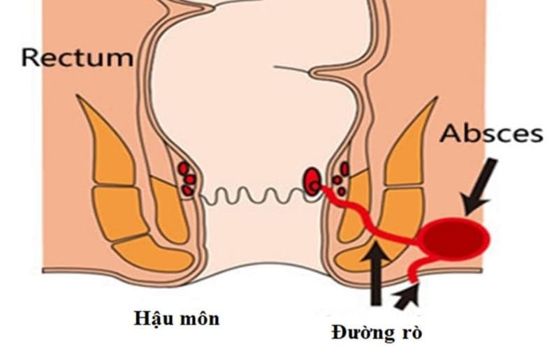 áp xe hậu môn và rò hậu môn