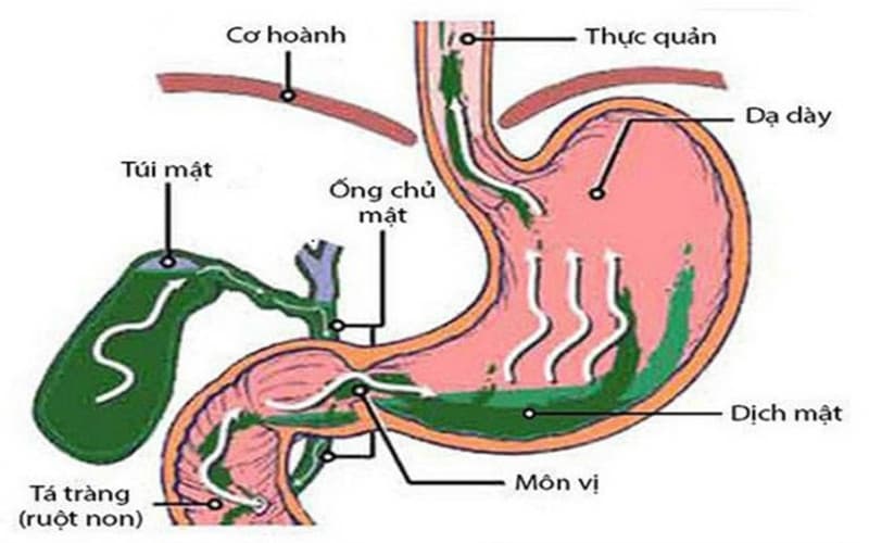 trào ngược dịch mật