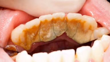 Sau khi lấy cao răng bao lâu thì được ăn?