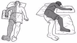 Tê nửa người là dấu hiệu bệnh gì?