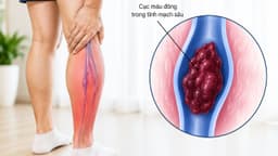 Tìm hiểu thang điểm đánh giá huyết khối tĩnh mạch sâu