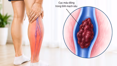 Tìm hiểu thang điểm đánh giá huyết khối tĩnh mạch sâu