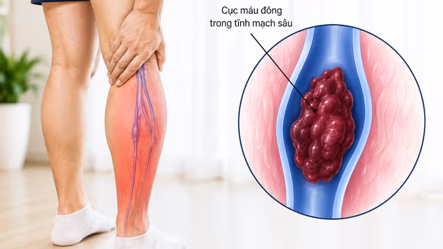 Tìm hiểu thang điểm đánh giá huyết khối tĩnh mạch sâu