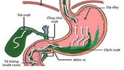 Trào ngược dịch mật là bệnh gì, dấu hiệu nhận biết và cách điều trị