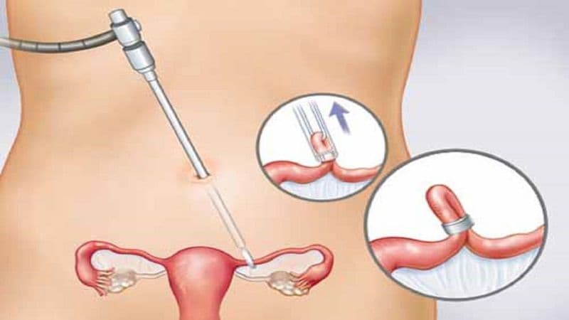 Có nên triệt sản khi sinh mổ lần 3?