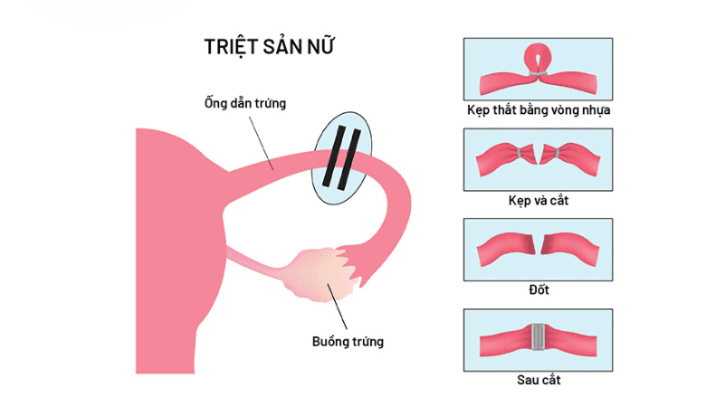 triệt sản nữ có ảnh hưởng nội tiết không