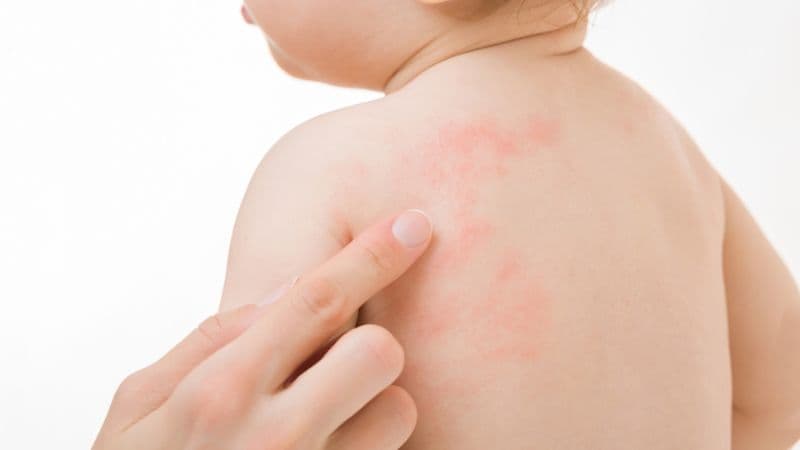 Triệu chứng sốt xuất huyết ở trẻ em 1 tuổi