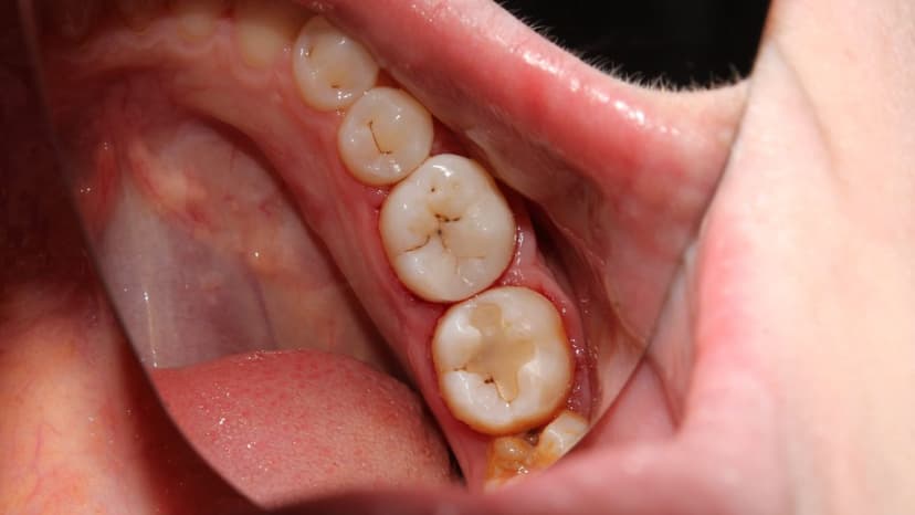 Vi khuẩn gây sâu răng sống ở đâu?