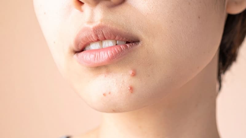 vị trí mụn trên mặt và dấu hiệu bệnh tật