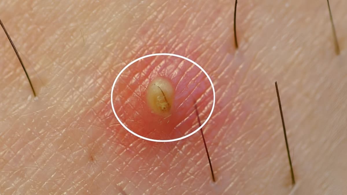 Viêm nang lông vùng kín là bệnh gì? Nguyên nhân