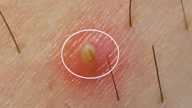 Viêm nang lông vùng kín là bệnh gì? Nguyên nhân