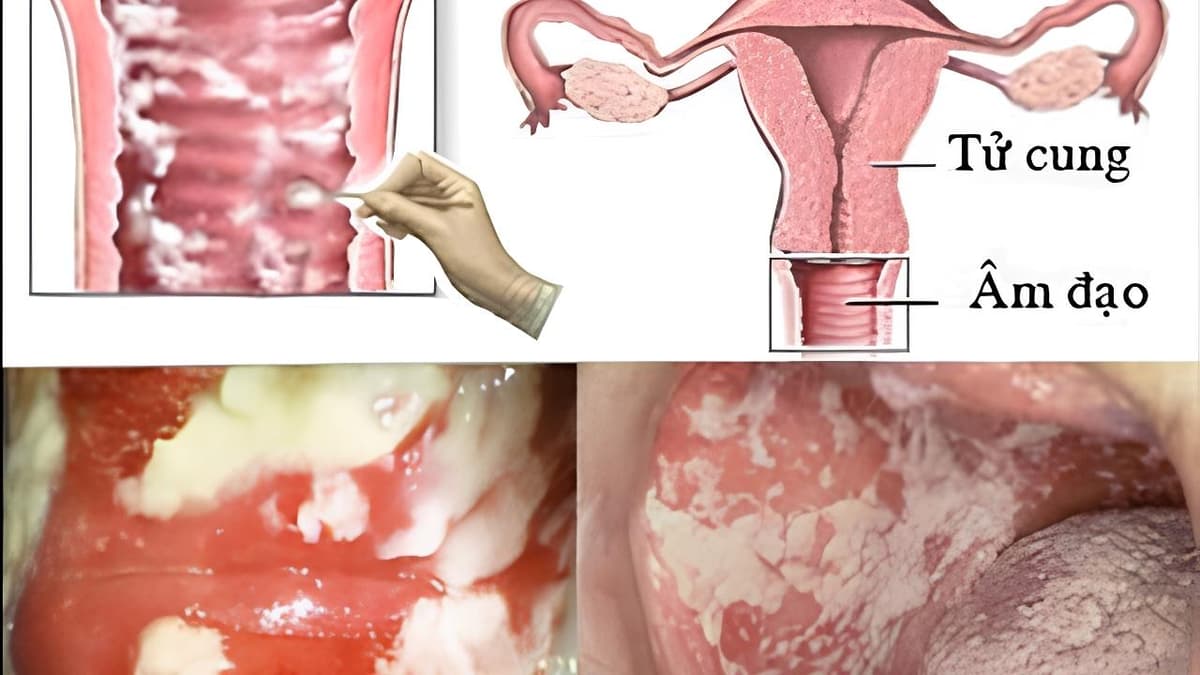 Viêm phụ khoa do nấm candida có chữa được không?