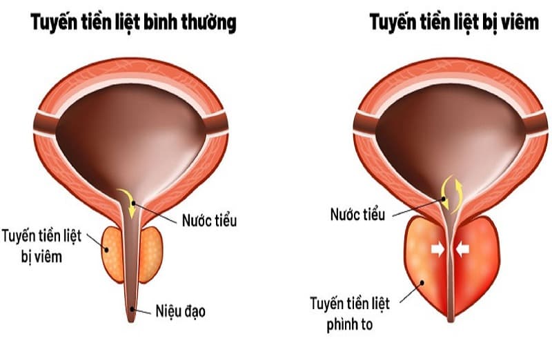 viêm tuyến tiền liệt