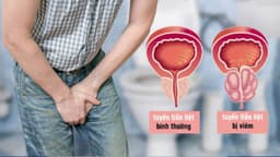 Viêm tuyến tiền liệt là gì? Dấu hiệu, nguyên nhân và cách điều trị