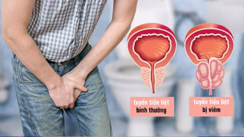 Viêm tuyến tiền liệt là gì? Dấu hiệu, nguyên nhân và cách điều trị