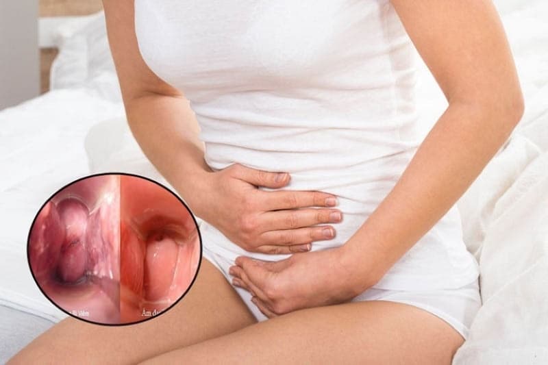 viêm vùng kín có ảnh hưởng đến kinh nguyệt không