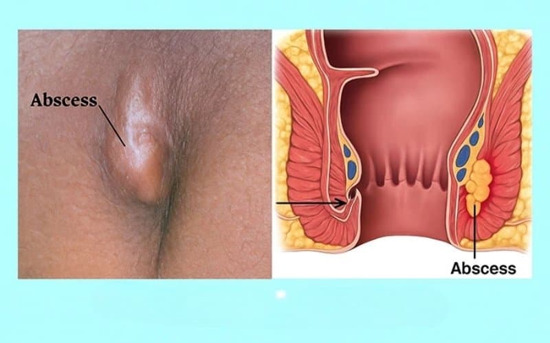 cách trị áp xe hậu môn tại nhà