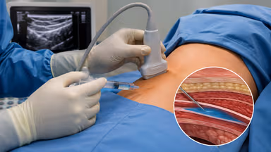 Gây tê TAP block: Giải pháp giảm đau hiệu quả cho phẫu thuật vùng bụng và chậu