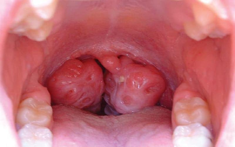 trẻ 6 tuổi ngủ ngáy có sao không