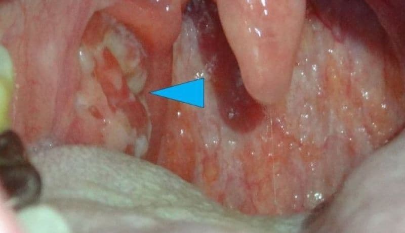 Bệnh lậu có thể gây nhiễm trùng tại nhiều vị trí như niệu đạo, cổ tử cung, trực tràng, họng và mắt.