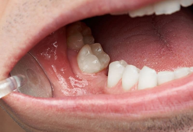 bệnh viêm lợi có nguy hiểm không