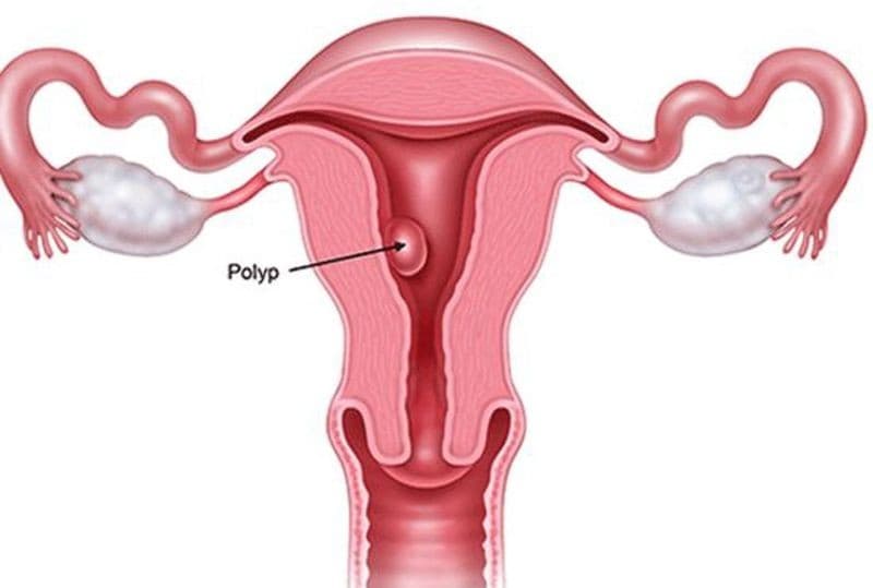 Bị polyp tử cung có nguy hiểm không và câu trả lời