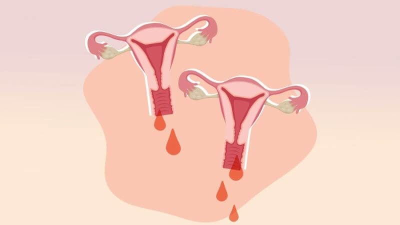 Bị polyp tử cung có nguy hiểm không và câu trả lời
