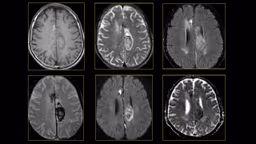 Các giai đoạn xuất huyết não trên MRI