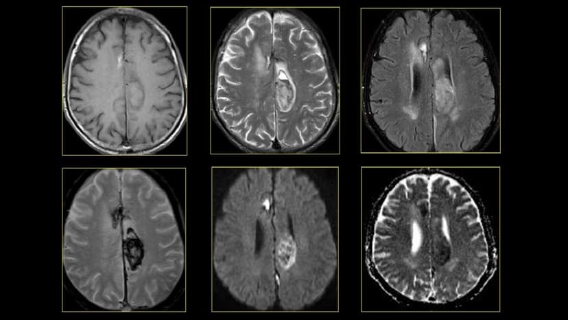 Các giai đoạn xuất huyết não trên MRI