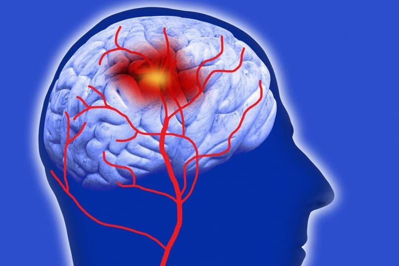 các giai đoạn xuất huyết não trên mri