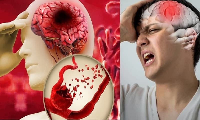 xuất huyết não có tái phát không