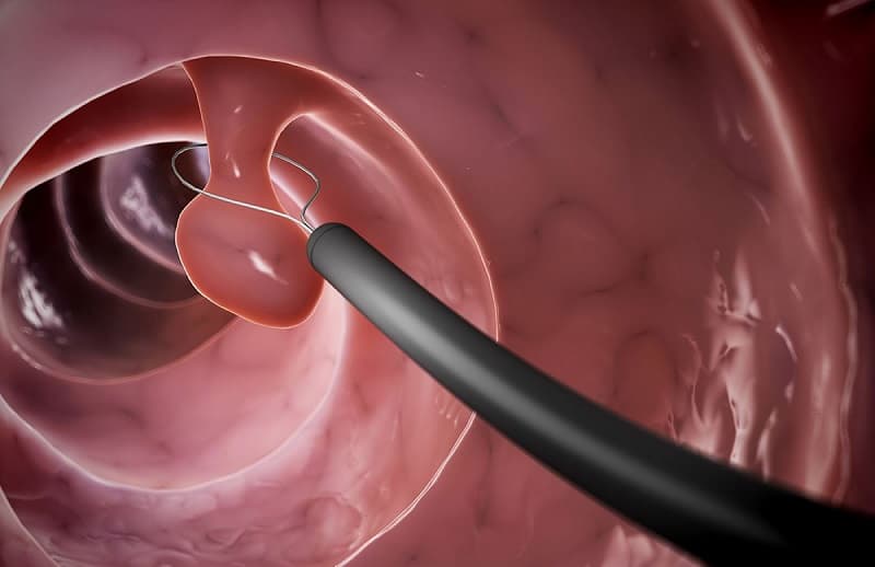 Polyp cổ tử cung bao lâu thành ung thư?
