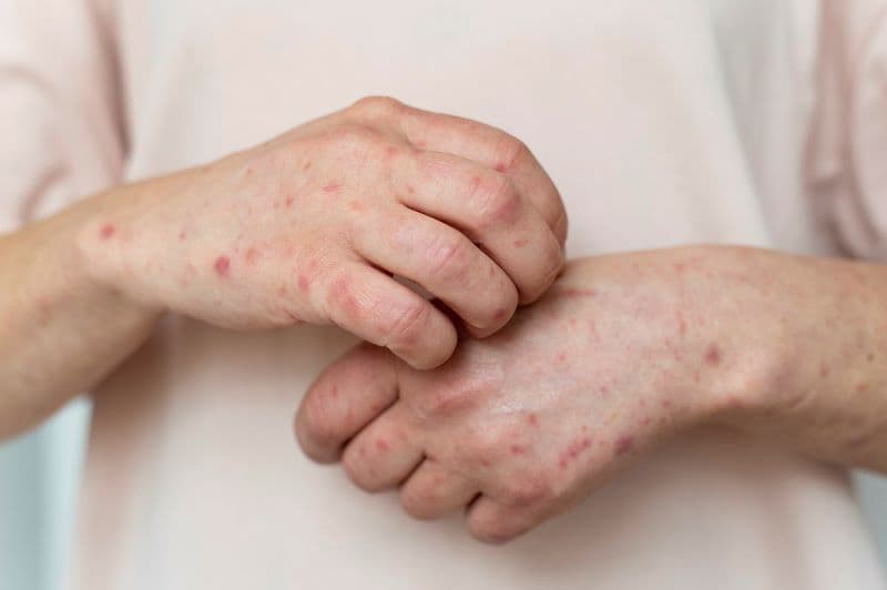 chi phí điều trị giang mai