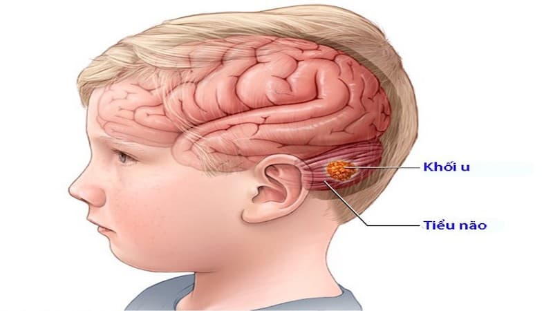 dấu hiệu u não ở trẻ em
