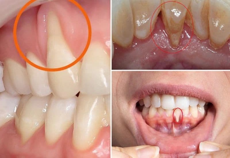 dấu hiệu tụt lợi