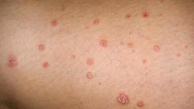 Điều trị giang mai ở Linh Đàm: Địa chỉ uy tín giúp chẩn đoán và điều trị kịp thời